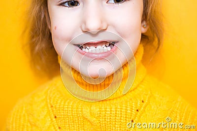 Girl shows her teeth-pathological bite, malocclusion, overbite. Pediatric dentistry and periodontics, bite correction. Health and Stock Photo