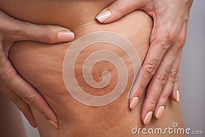 Girl shows holding and pushing the skin of the legs cellulite, orange peel. Stock Photo