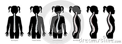 Girl spinal deformity flat vector illustration Vector Illustration