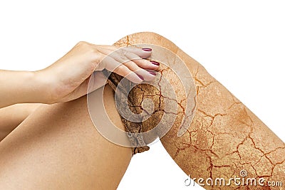 Girl takes off her pantyhose with dry skin. Cracks in the skin of the legs. Stock Photo