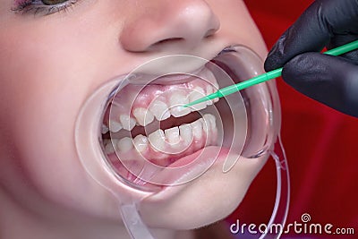 Girl on teeth whitening procedure with open mouth Stock Photo