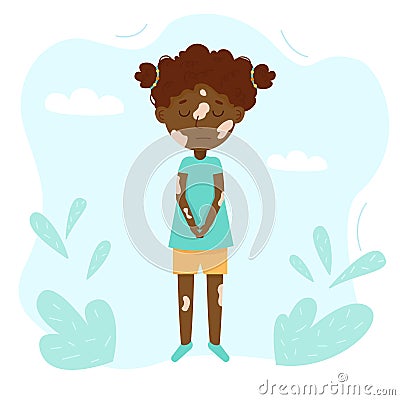 Girl with vitiligo cosmetology skin disease. Vector illustration Vector Illustration