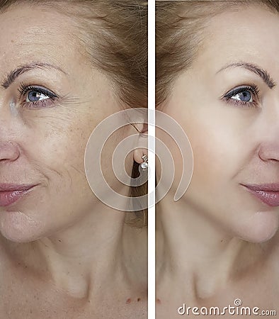 Girl wrinkles before and after removal crease Stock Photo