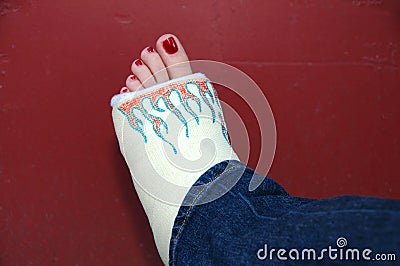 Girls Broken Leg Stock Photo