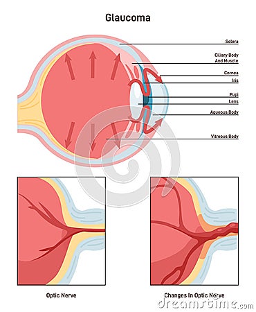 Glaucoma. Damage to the optic nerve and can lead to vision loss. Cartoon Illustration