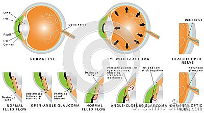 Glaucoma Vector Illustration