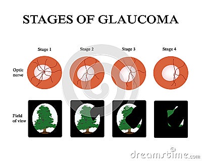 Glaucoma. The field of vision in glaucoma. Atrophy of the optic nerve. Infographics. Vector illustration Vector Illustration