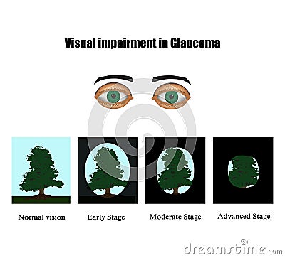 Glaucoma. The field of vision in glaucoma. Infographics. Vector illustration on background Vector Illustration