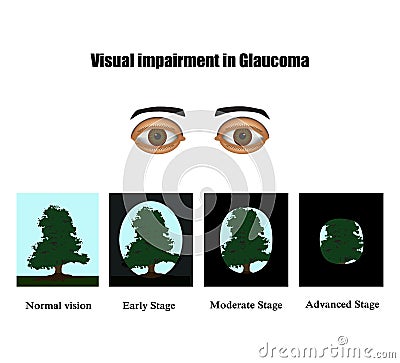 Glaucoma. The field of vision in glaucoma. Infographics. Vector illustration on background Vector Illustration