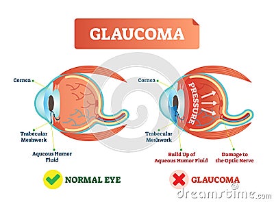 Vector illustration of glaucom. Cross section with damaged eye. Scheme with cornea, trabecular meshwork and aqueous humor fluid. Vector Illustration