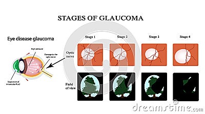 Glaucoma. The structure of the eye. The field of vision in glaucoma. Atrophy of the optic nerve. Infographics. Vector Vector Illustration