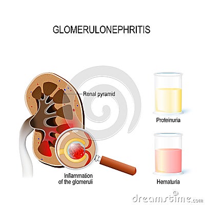 Glomerulonephritis glomerular nephritis. Human kidney, and clo Vector Illustration