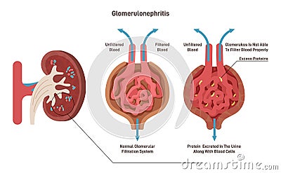 Glomerulonephritis or glomerular nephritis. Kidney disease, inflammation Vector Illustration