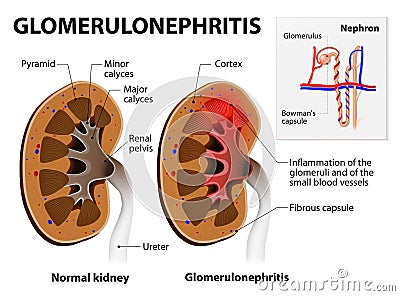 Glomerulonephritis or glomerular nephritis. kidney disease Vector Illustration