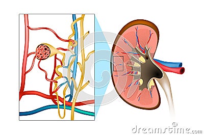 Glomerulonephritis GN Vector Illustration