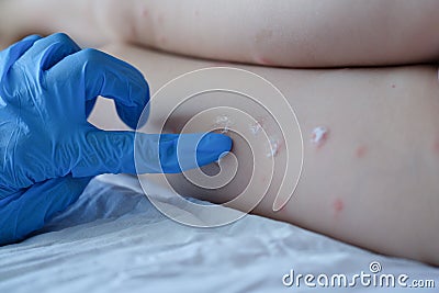 Gloved doctor applies the cream to baby skin after insect mowing Stock Photo