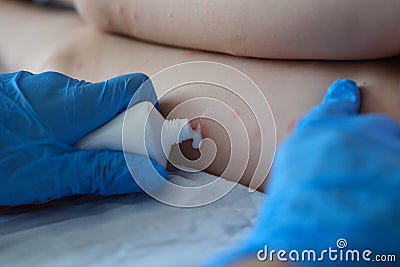 Gloved doctor applies the cream to skin of patient with red itchy inflammations Stock Photo