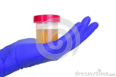 A gloved doctor hand with the urine container for medical urine test. A photo of urine specimen, medical analysis in the laborator Stock Photo
