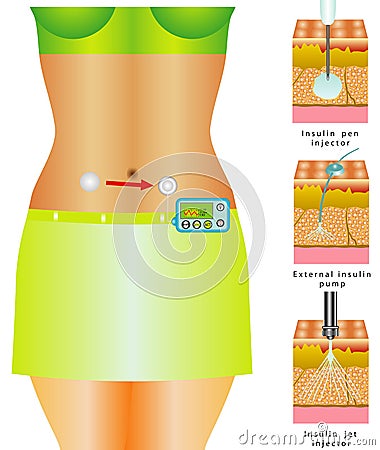 Glucose Monitoring Stock Photo