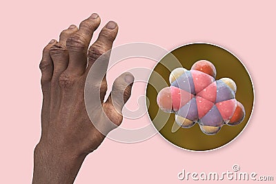 Gout-afflicted hands with deformities, 3D illustration Cartoon Illustration