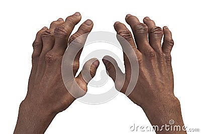 Gout-afflicted hands with deformities, 3D illustration Cartoon Illustration