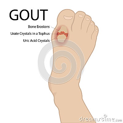 Gout arthritis. Human foot. Vector medical illustration. Vector Illustration