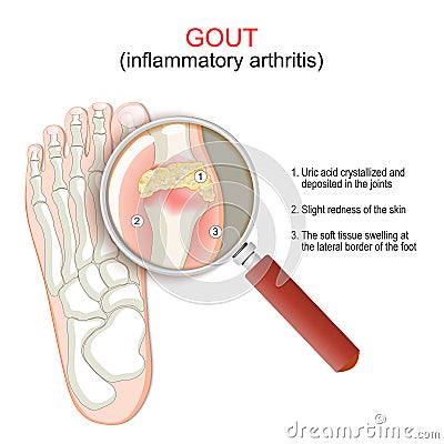 Gout. Close-up of joint with inflammatory arthritis Vector Illustration