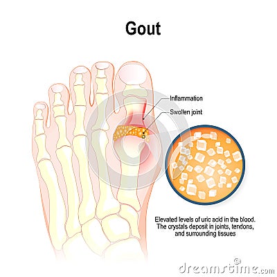 Gout is a form of inflammatory arthritis. Vector Illustration