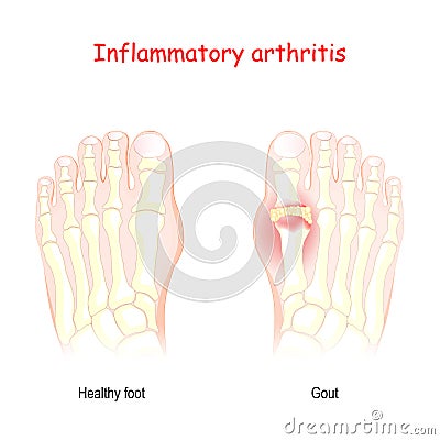 Gout. inflammatory arthritis Vector Illustration