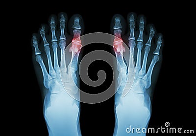 Gout , Rheumatoid arthritis ( Film x-ray both foot and arthritis at first metatarsophalangeal joint ) ( Medicine and Science Stock Photo