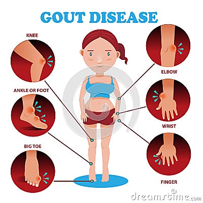 Gout symptoms Vector Illustration