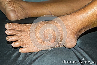 Gouty arthritis Stock Photo