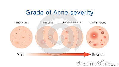 Grade of acne severity. Medical diagram about skin problems from acne. Vector Illustration