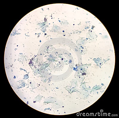 Gram stain of Arcanobacterium haemolyticum colony showing irregularly shaped gram-positive rods recovered from blood culture. Stock Photo