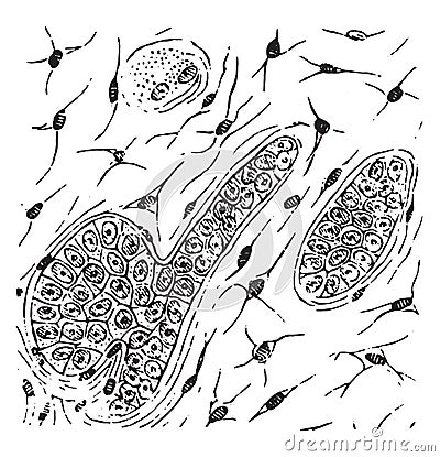 Grandular carcinoma in which the stroma has converted into mucoid tissue, vintage engraving Vector Illustration