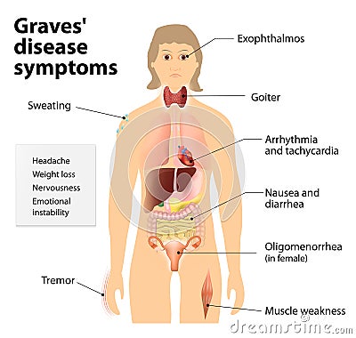 Graves' disease or Basedow disease. Symptoms and signs Vector Illustration