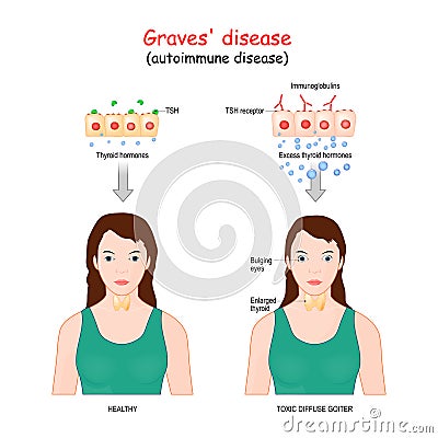 Graves` disease. toxic diffuse goiter is an autoimmune disease that affects the thyroid Vector Illustration