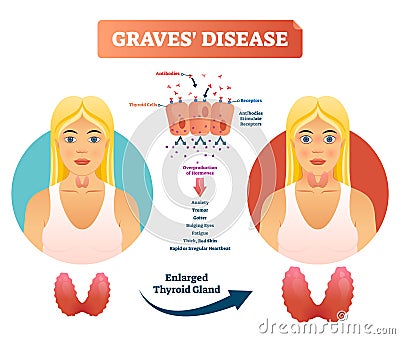 Graves disease vector illustration. Labeled diagnosis symptoms diagram Vector Illustration