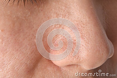 Greasy oily face and comedones, Skin problem with acne scar diseases, Close up woman face Stock Photo