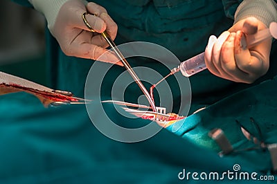 Greater saphenous vein harvest for venous conduit Stock Photo