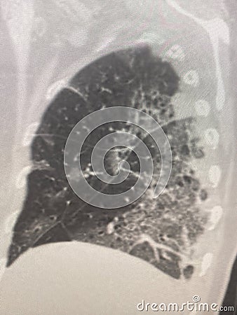 Chest CT Scan of novel Coronavirus COVID-19 Stock Photo