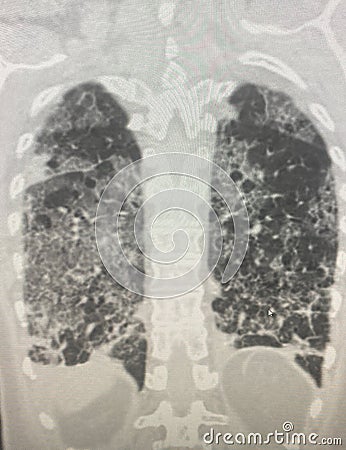 Chest CT Scan of novel Coronavirus COVID-19 Stock Photo