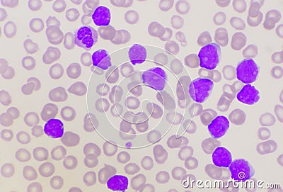 Group of blast cells in leukemia background Stock Photo