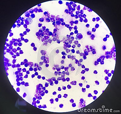 Group of inflammation cells ascitic fluid sample Stock Photo