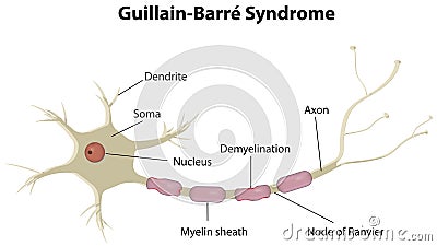 Guillain Barre Disease Vector Illustration