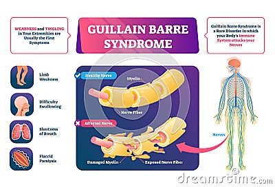 Guillain Barre syndrome vector illustration. Labeled muscle disease scheme. Vector Illustration