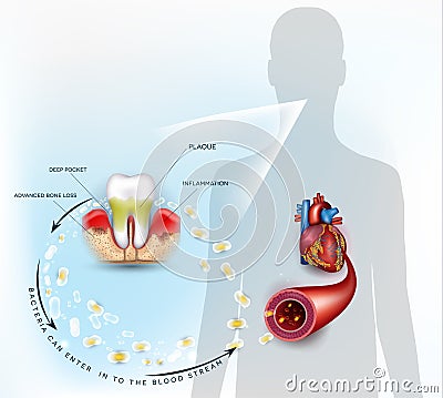 Gum disease inflammation bacteria Vector Illustration