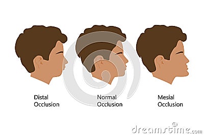 Guy with Distal, Normal, and Mesial bite profile, vector illustration. Overbite or underbite before and after Vector Illustration