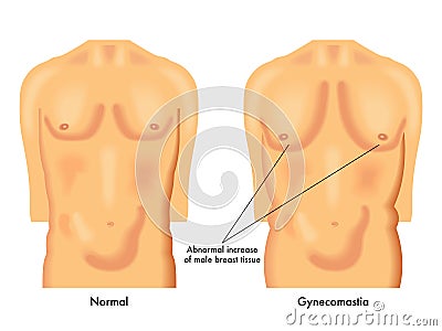 Gynecomastia Vector Illustration