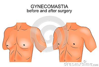Gynecomasty. before and after surgery Vector Illustration
